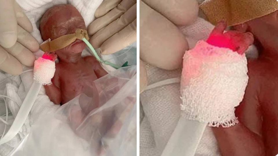 В Германии женщина родила на 6 месяце беременности - ребенок чудом выжил: