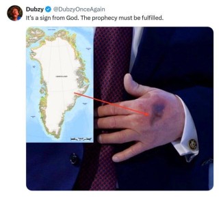 Трамп сказал, что синяк на его руке появился из-за того, что он ударился об стол