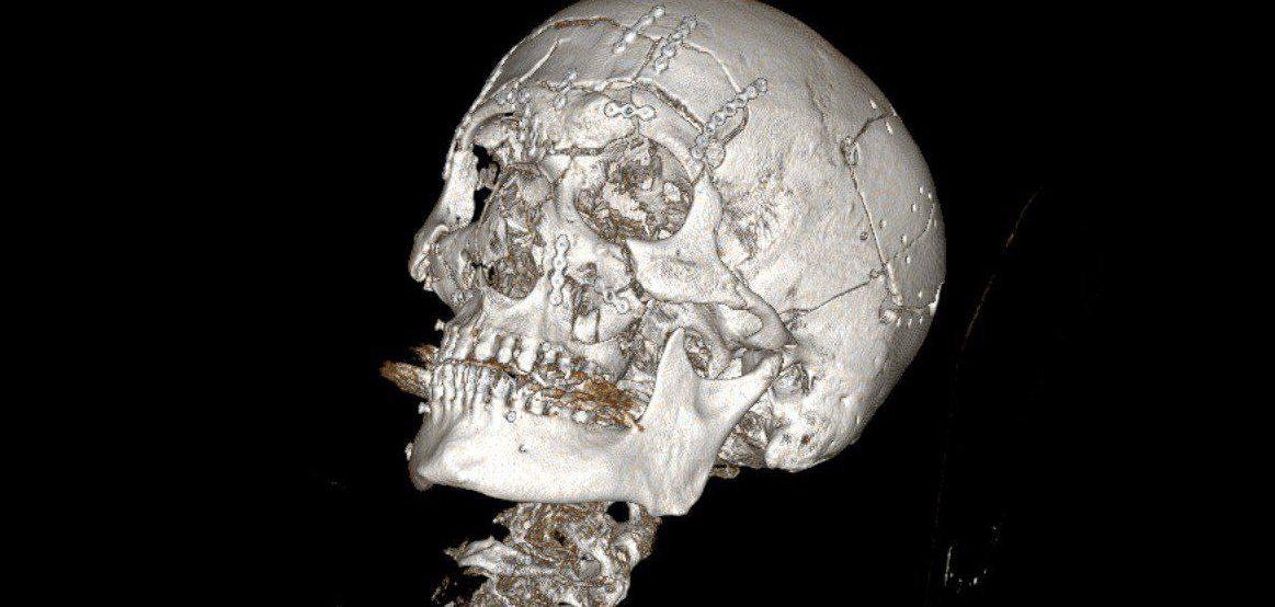 Подмосковные хирурги заново "собрали" лицо упавшему со снегохода мужчине