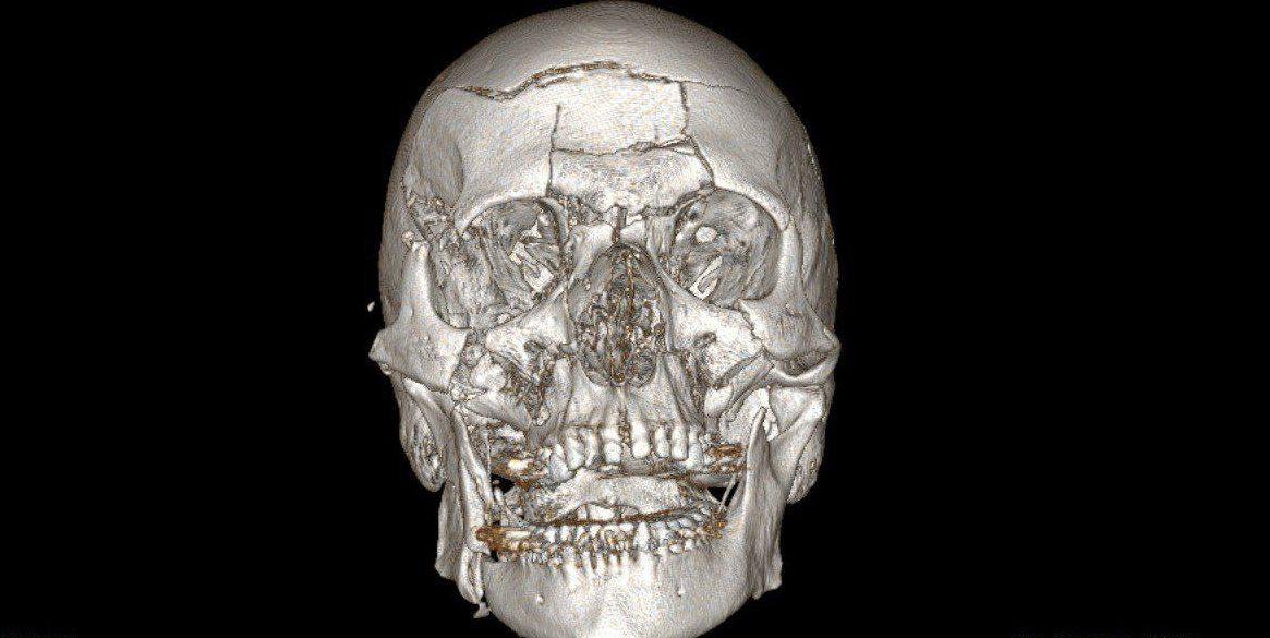 Подмосковные хирурги заново "собрали" лицо упавшему со снегохода мужчине Подмосковные хирурги заново "собрали" лицо упавшему со снегохода мужчине