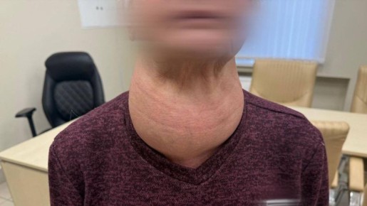 В Татарстане женщине удалили щитовидную железу размером с голову: