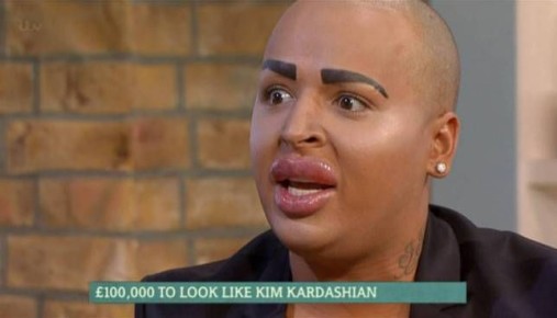 "Король губ" из Британии скончался на операционном столе